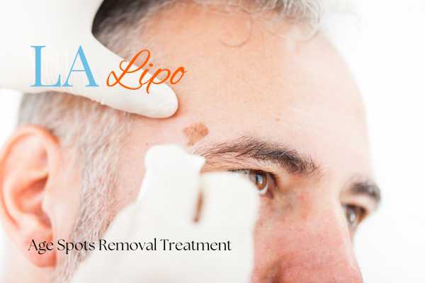 What Are the Most Effective Treatments for Age Spots Beccles?
