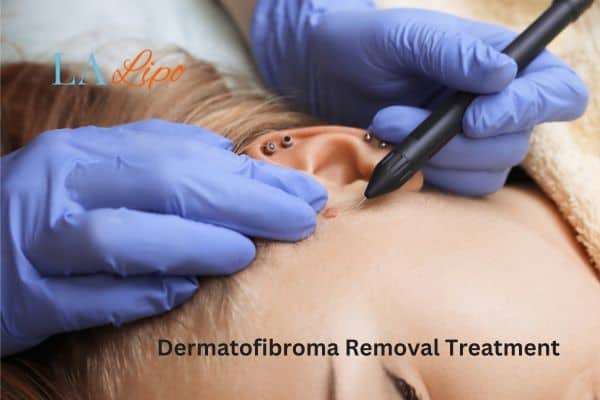 Dermatofibroma Removal Treatment Beccles