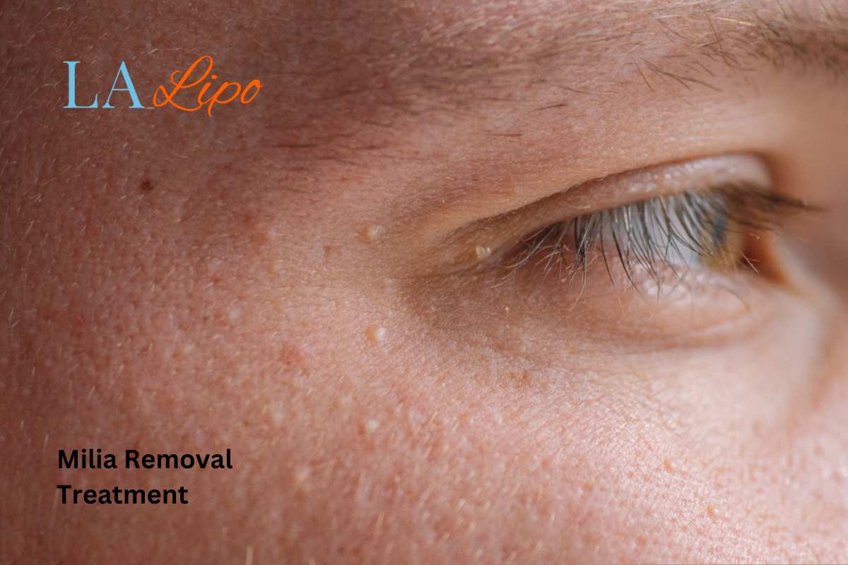 Cryopen Milia Removal: Is It the Easiest and Safest Option Beccles?