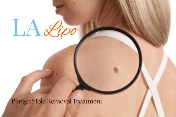 Woman having her inspection of blemish before mole removal Beccles
