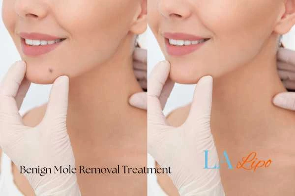 Before and after mole removal Beccles treatment