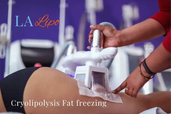 women getting fat freezing Beccles