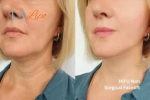 hi-fu for wrinkles Beccles before and after results