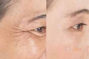 Before and after results of woman - HI-fu wrinkles reduction treatment Beccles