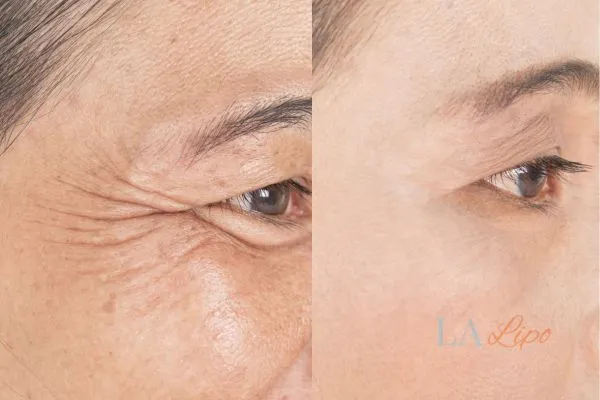 Before and after results of woman - HI-fu wrinkles reduction treatment Beccles