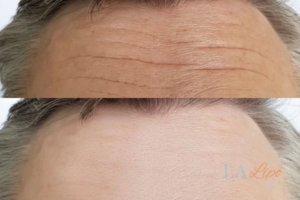 results of HIFU Beccles on mans forehead to help reduce lines and wrinkles