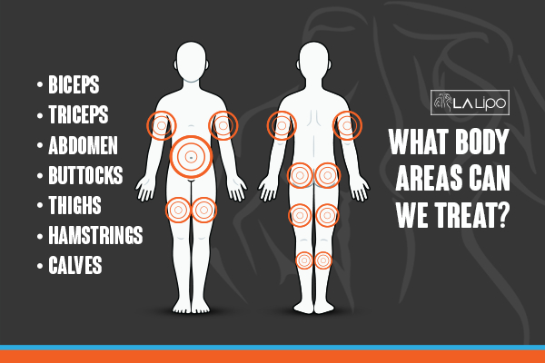 Graphic to show areas you can have LA-EMS Body Sculpting Beccles treatment.