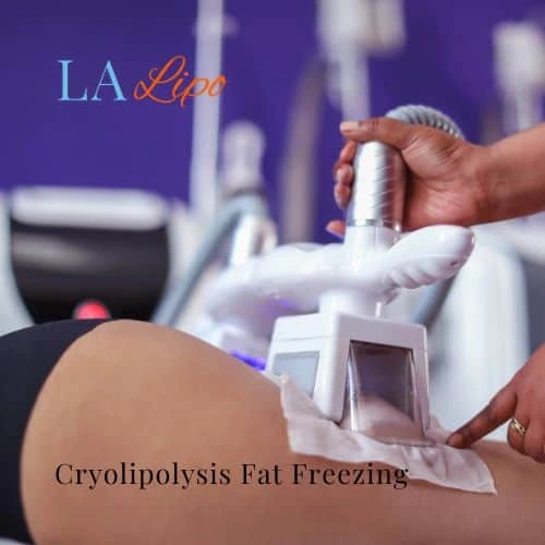 fat freezing - Cryolipolysis Beccles