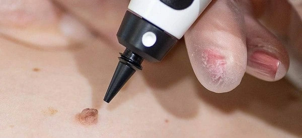 skin tag removal using cryopen Beccles