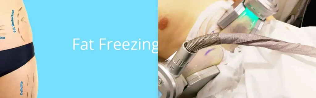 Fat freezing Beccles on multiple areas of the body