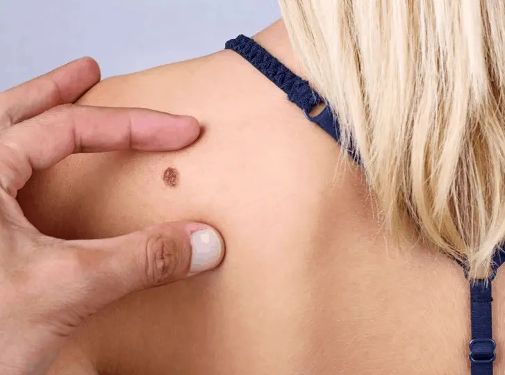woman having mole removal Beccles consultation before treatment.