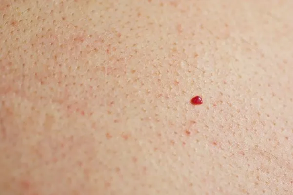 close up of a cherry angioma Beccles