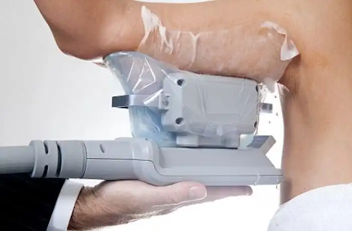 Picture of fat freezing Beccles on the upper arms.