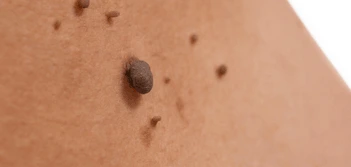 image of a skin tag Beccles