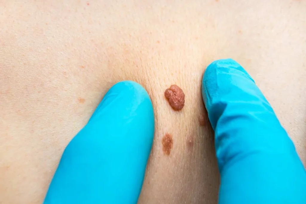 Consultant examining a skin tag Beccles