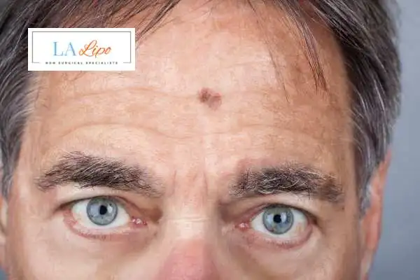 Solar Lentigo Removal Beccles image of man with mark on his forehead