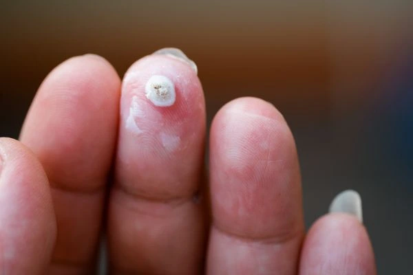 wart on person finger - cryotherapy to treat from LA LIPO Beccles