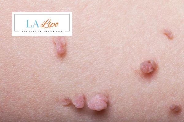 Does cryopen skin tag removal Beccles hurt? Find out now call our team today!
