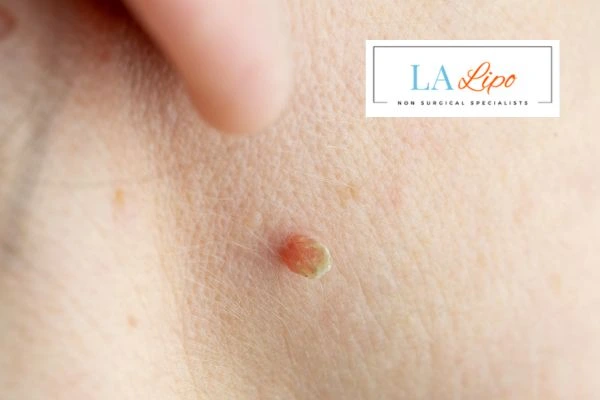 Book skin tag removal Beccles today speak to our team now!