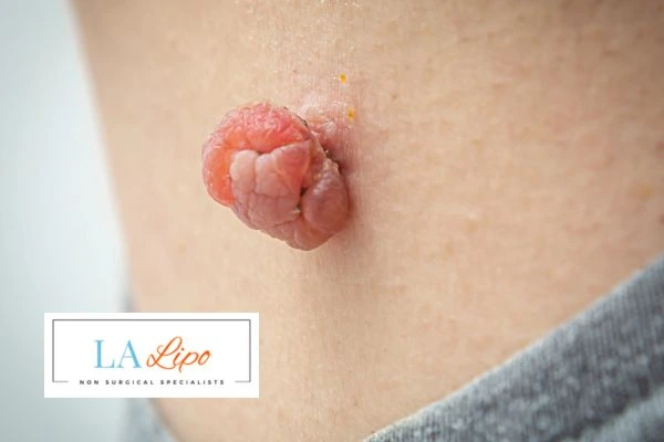 Interested in skin tag removal Beccles? Concerned about the pain? Find out more today!