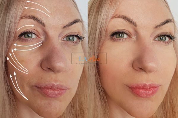 Morpheus 8 results Beccles face lift.