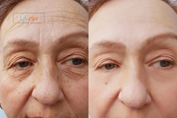 The powerful benefits of Morpheus8 Treatment Beccles - Call Our team today!