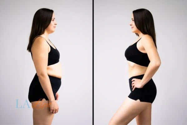 Picture of womans before and after using LA-EMS body sculpting to improve her core strength Beccles