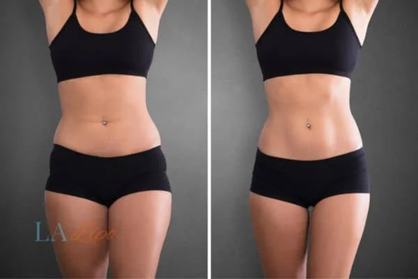 before and after results of non-surgical treatment to help a woman's body image and mental health Beccles