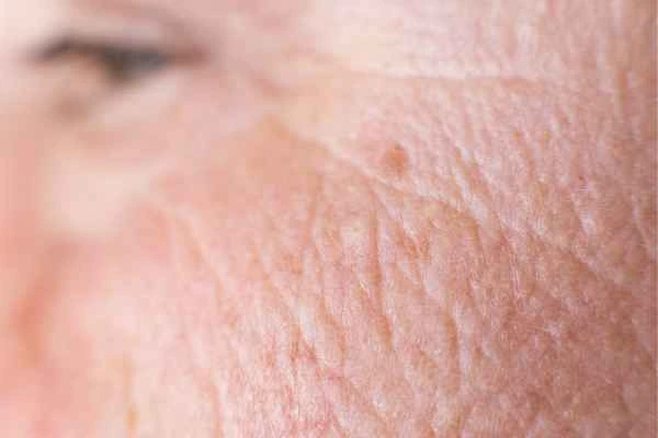 close up picture of a woman's face showing an age spot Beccles
