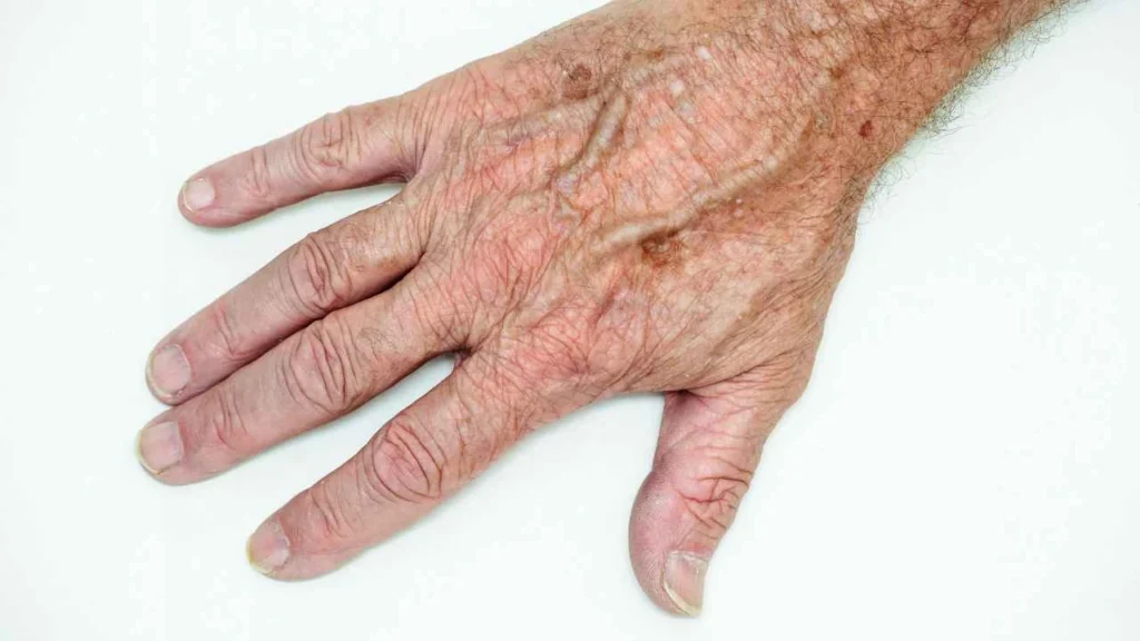 Male hand showing age spot Beccles