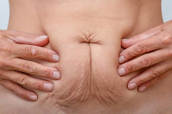 Image of a woman's stomach with loose skin - example of skin tightening Beccles options