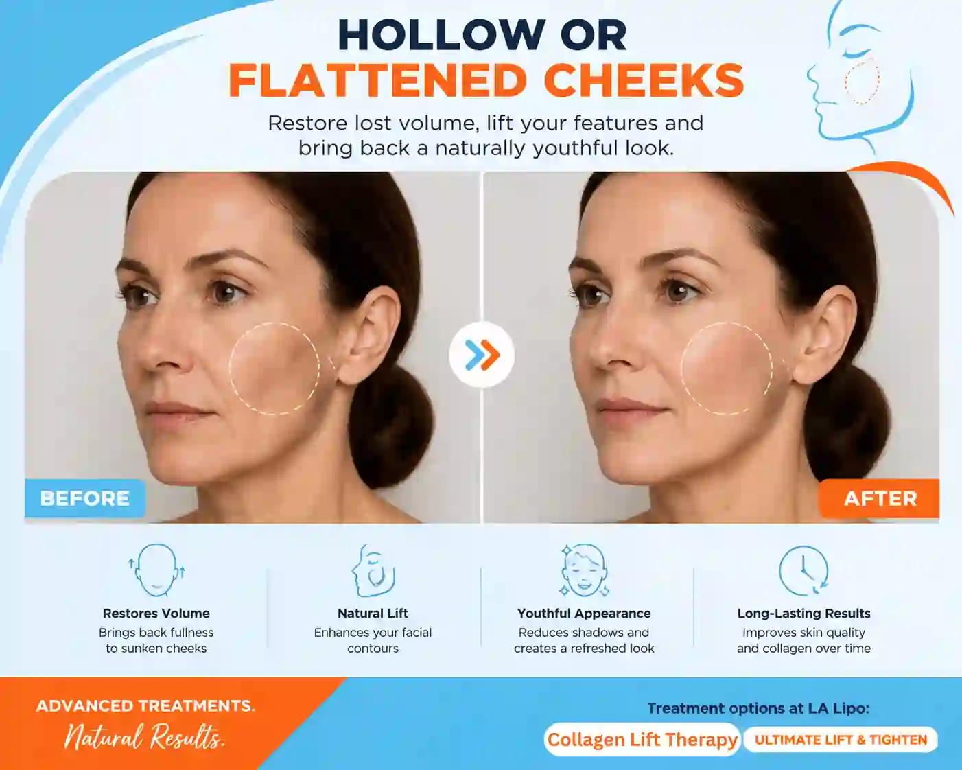 Sign #4: Hollow or Flattened Cheeks Beccles