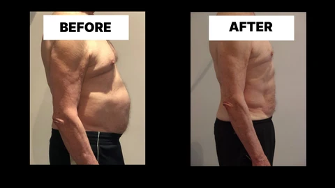 What Symptoms Can Diastasis Recti Cause in Men? Weak Core, Back Pain and Poor Posture Beccles